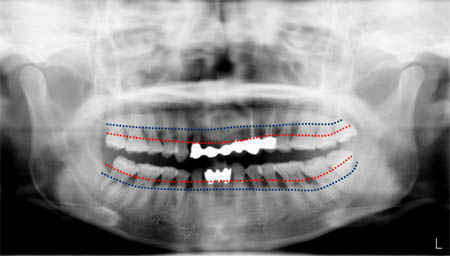 *빨간 점선 : 정상적 잇몸 상태의 치조골 높이. *파란 점선 : 치주질환이 있는 잇몸 상태의 치조골 높이. ⓒ김기영