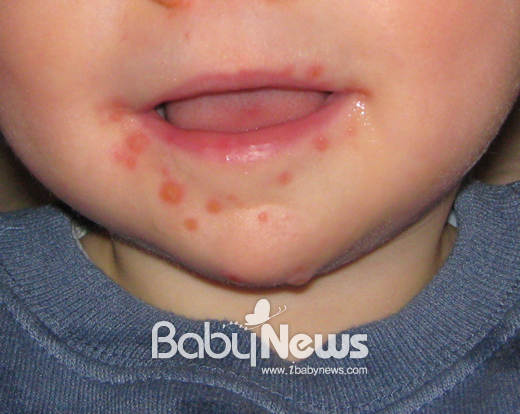 수족구병에 걸린 아이. 입 주변으로 수포성 병변이 생겨있는 것을 볼 수 있다. ⓒ위키백과