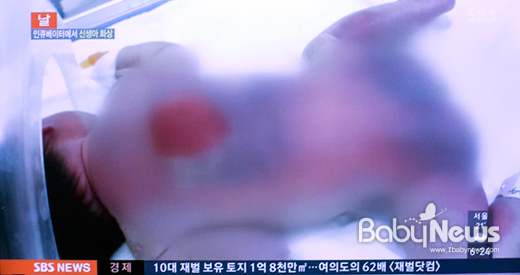 안동 산부인과병원에서 화상을 입은 신생아의 모습. 사진은 SBS 뉴스 보도화면. ⓒSBS