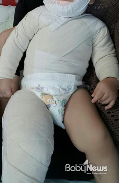 경기 시흥의 한 어린이집에서 커피포트가 쓰러져 생후 12개월된 아이가 전신에 2도 화상을 입는 사고가 발생했다. 사진은 아이 엄마가 SNS에 올린 아이 모습. ⓒC군 어머니 SNS