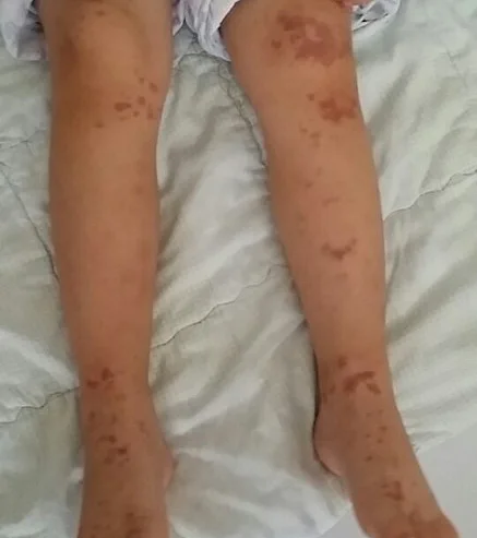 - 헤노흐 쇤라인 자반병 -