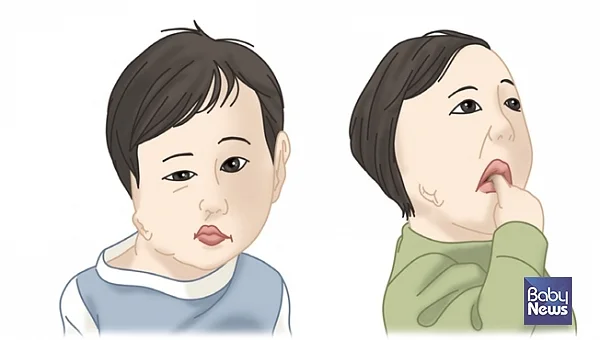 아기의 안면 비대칭은 대부분 심각하지 않지만 기능 이상이나 구조적 질환이 원인일 수 있어 증상이 지속되거나 악화되면 조기에 전문 진료를 받아야 한다.?ⓒ베이비뉴스
