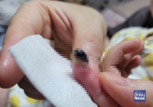 오토 폴딩 유모차에 의해 손가락 끼임 사고가 발생해 아기 손가락이 절단되는 사고가 발생했다. 사진은 피해자가 인터넷 커뮤니티에 공개한 사진. ⓒ피해자 A씨