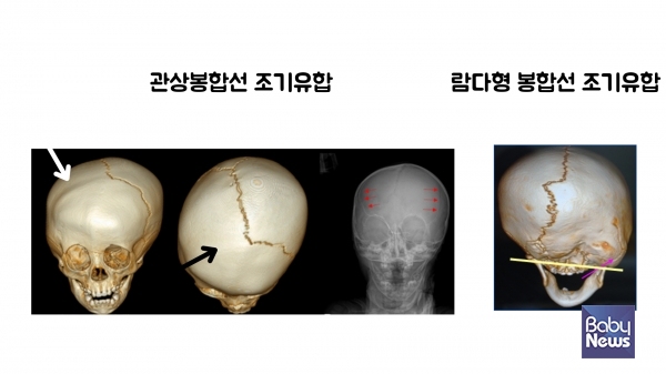 관상봉합선 조기유합과 람다형 봉합성 조기유합 비교. ⓒ임신영