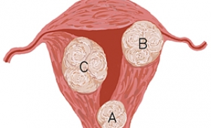 태아와 산모 건강 위협하는 자궁근종